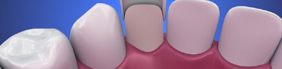 Veneers - Nine One Dental