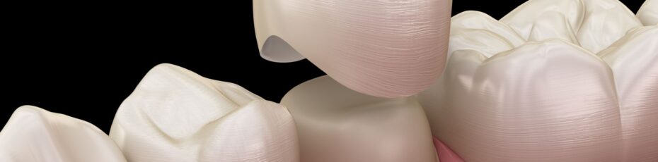 dental crowns near you