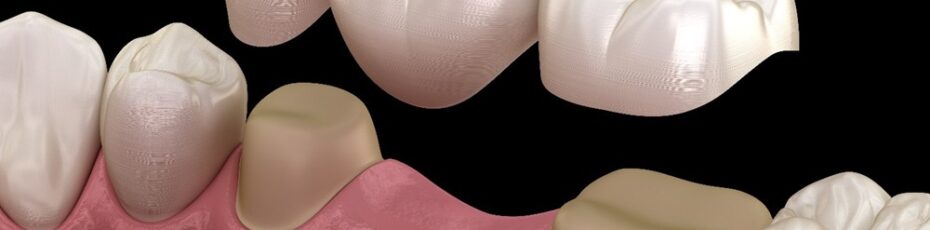 dental bridges near you