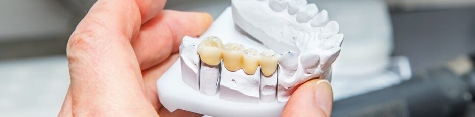 dental bridges near you