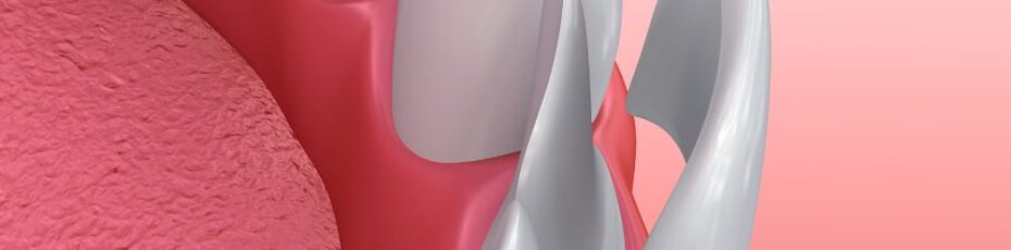 Porcelain Veneers in West Roxbury