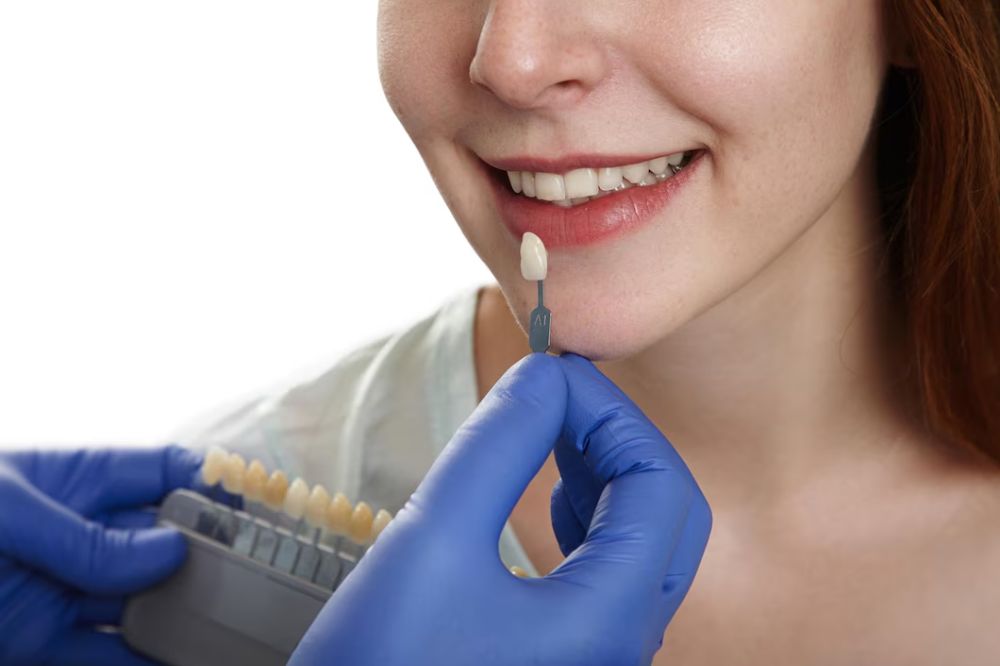 dental bridges