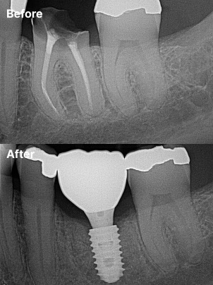 Before-and-after result for single-tooth implant case 21 at Nine One Dental