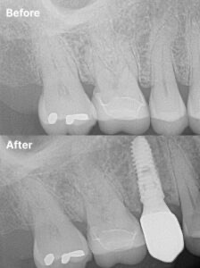 Before-and-after result for single-tooth implant case 20 at Nine One Dental