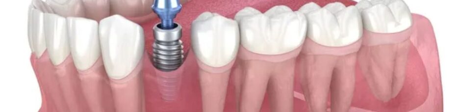 Dental Implants Near You