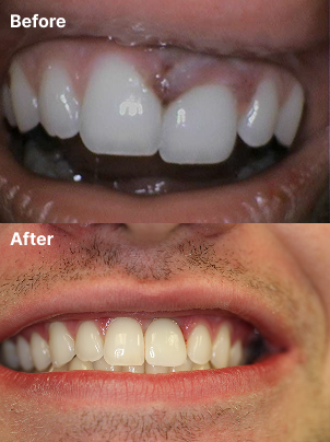 Immediate front-tooth implant result case 01 at Nine One Dental