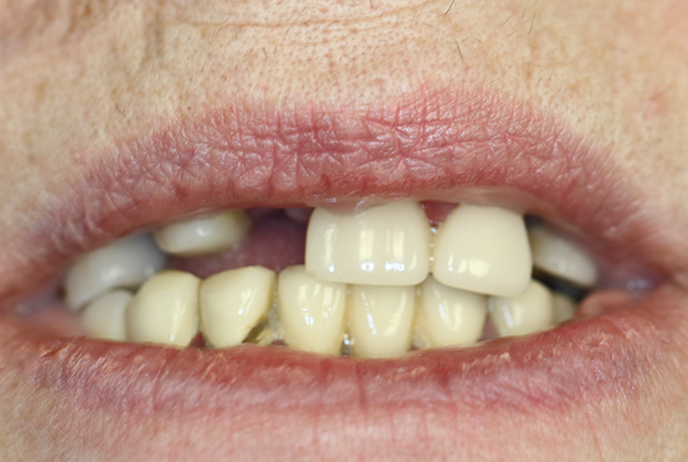 Dental implant treatment before photo at Nine One Dental
