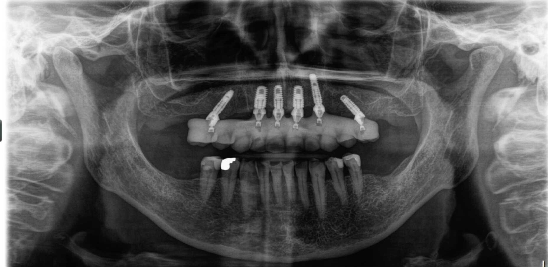 After treatment: Replacing an unstable upper bridge